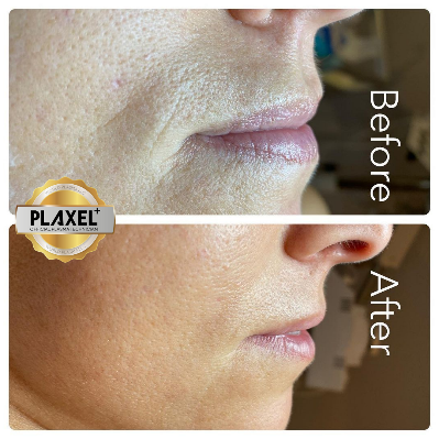Before and after Fine Line Removal